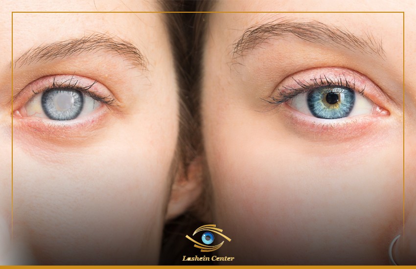 عمليات تصحيح الإبصار